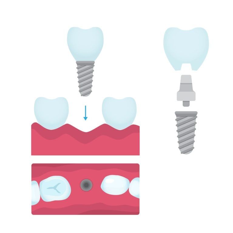 Tooth Replacement Procedure