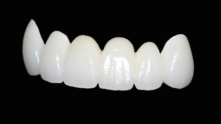 What are Zirconia Crowns?