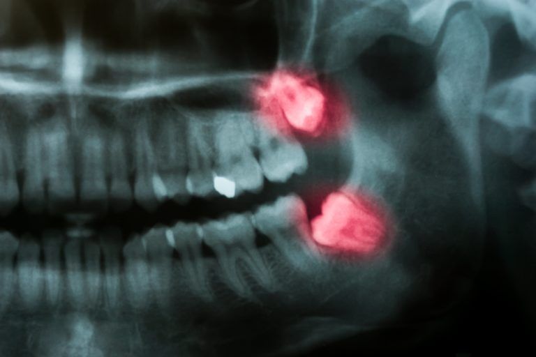 What Does It Mean For A Tooth To Be Impacted?