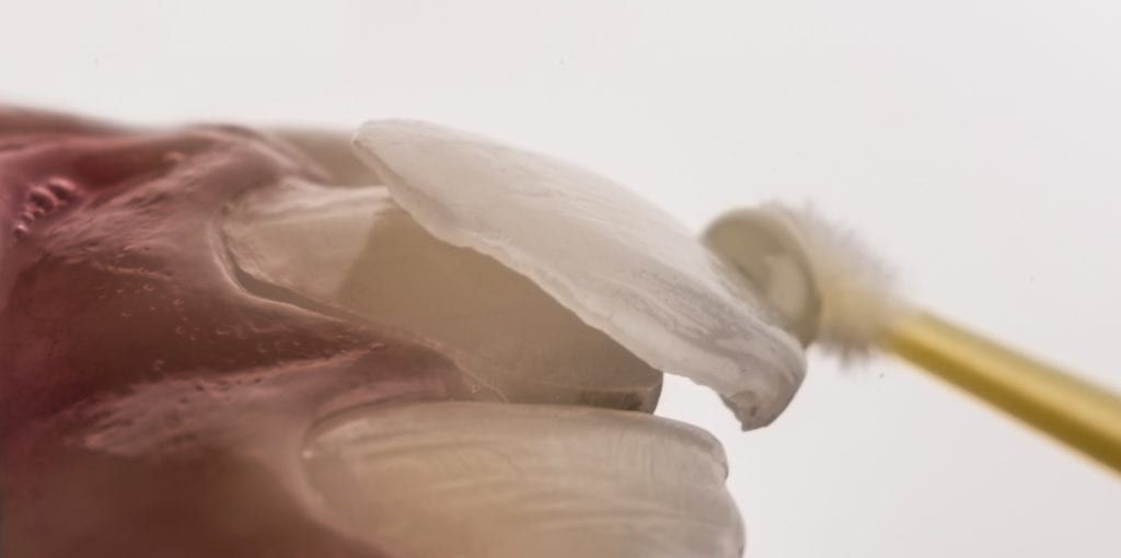 Veneer being applied to tooth
