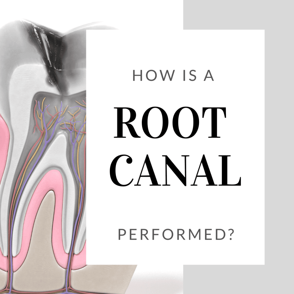 How is a Root Canal Performed