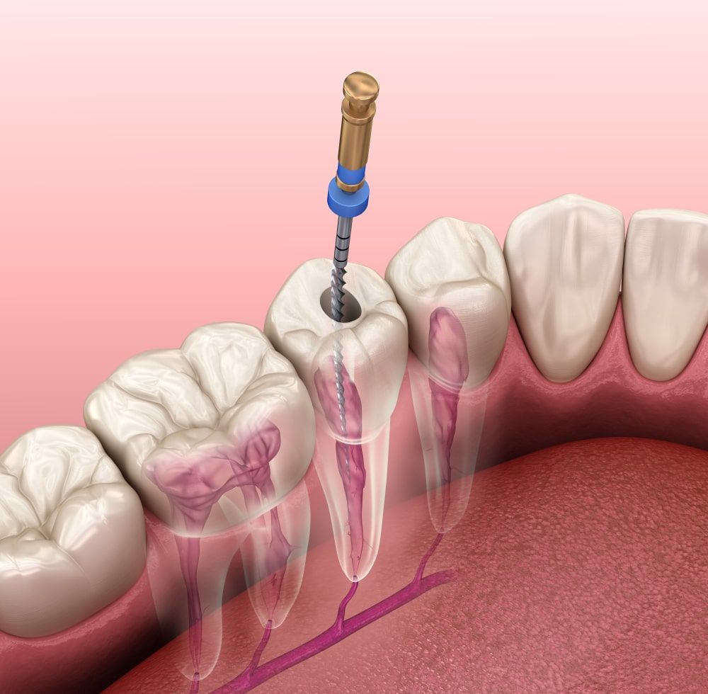 Root canal file being used during a root canal