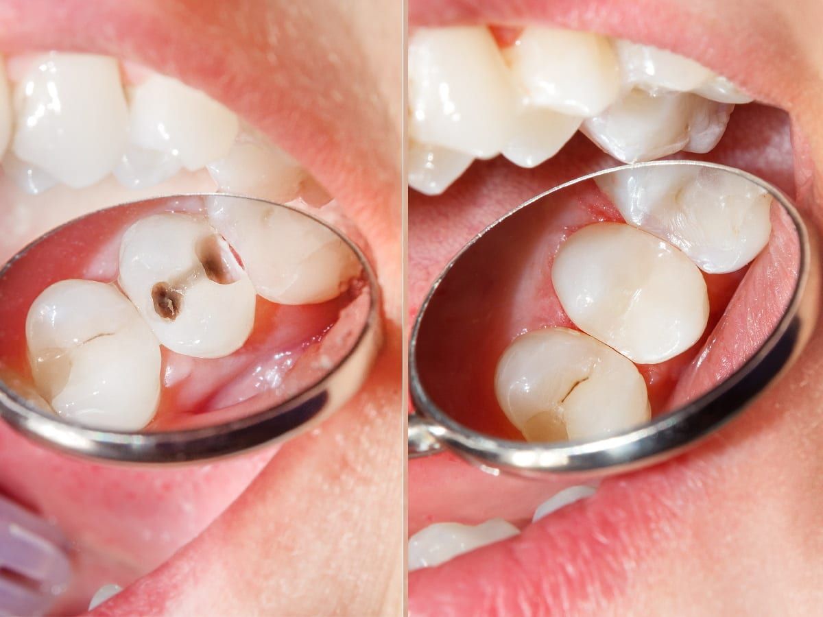 What You Can Do with a Lost Dental Filling