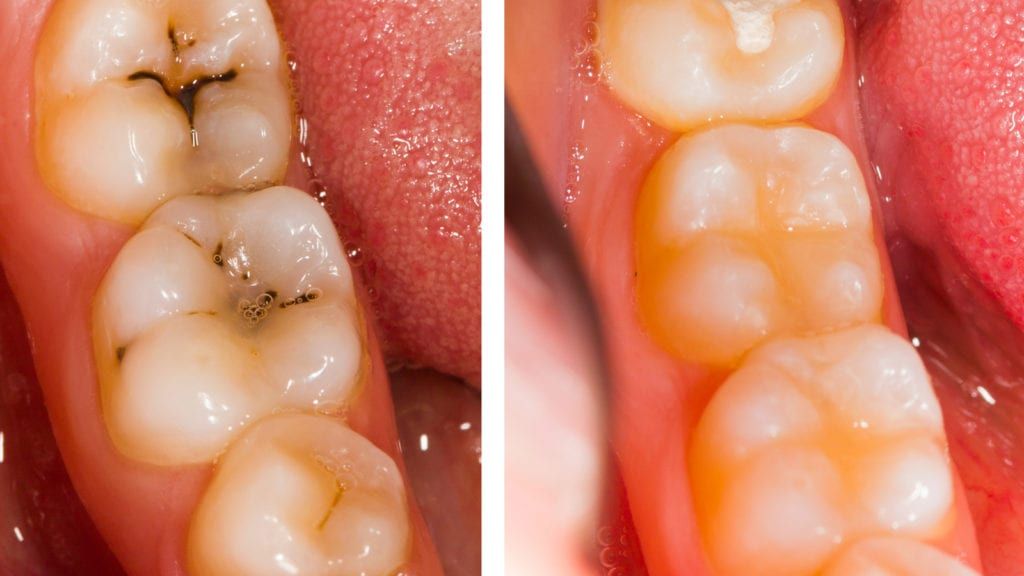 Teeth before and after fillings