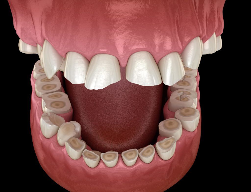 tooth enamel eroded by bruxism