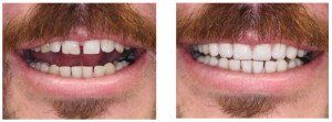dental-bonding-before-after-300x111