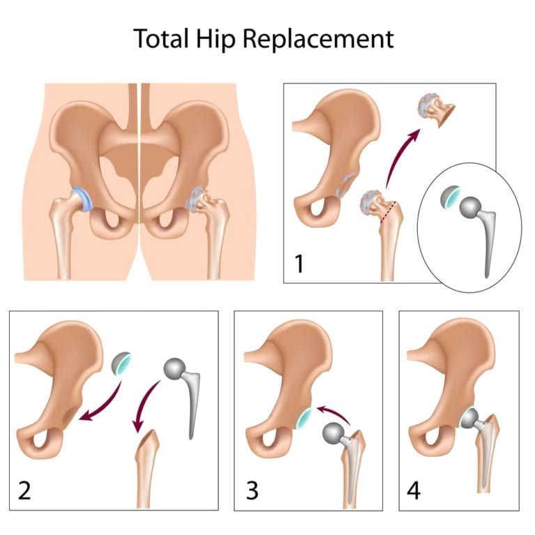 Revision Rotator Cuff Repair Las Vegas