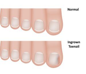 Ingrown Toenail