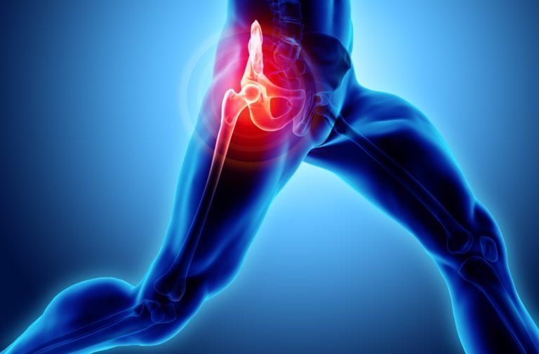 Signs you need a hip replacement
