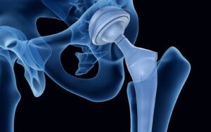 Hip replacement x-ray