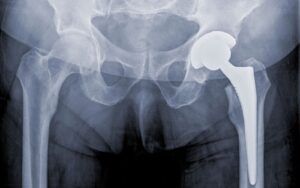 Hip transplant x-ray