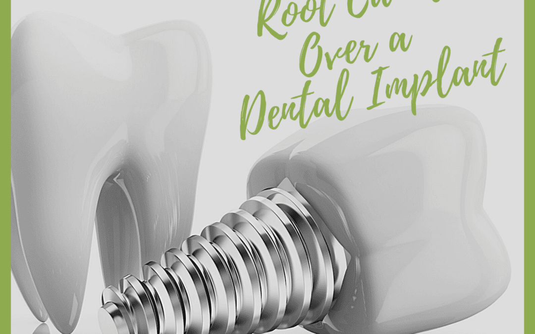 Why to Choose a Root Canal Over a Dental Implant