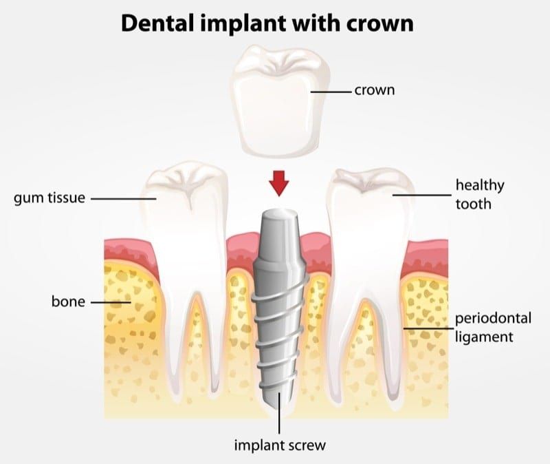 dental implant vs natural tooth