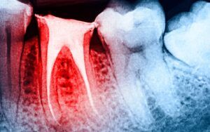 Root Canal X-Ray