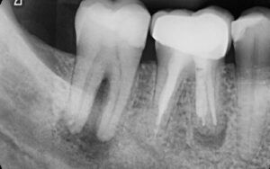 X-Ray of Dental Pulp