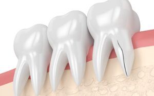3D Vector Rendered Image of Teeth with a Vertical Root Fracture