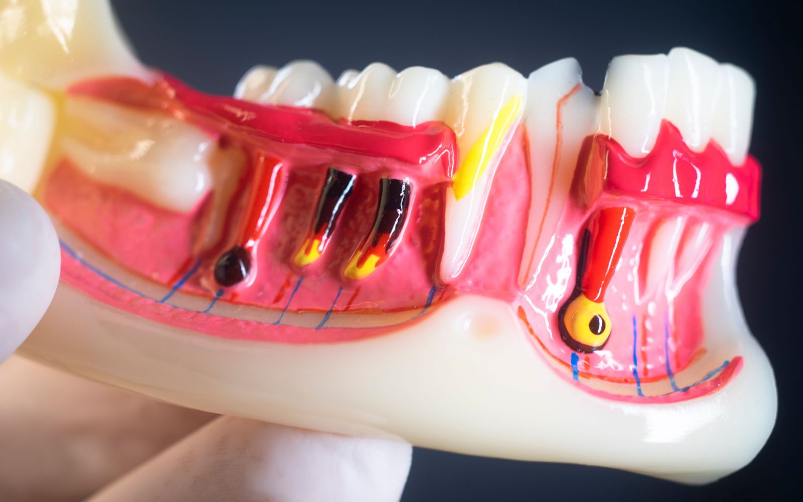 The Difference Between An Apicoectomy and a Root Canal - Raleigh ...