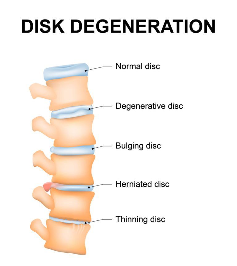 Degenerative Disc Disease » Fort Worth Neurosurgeon - Dr. Diana Wilson