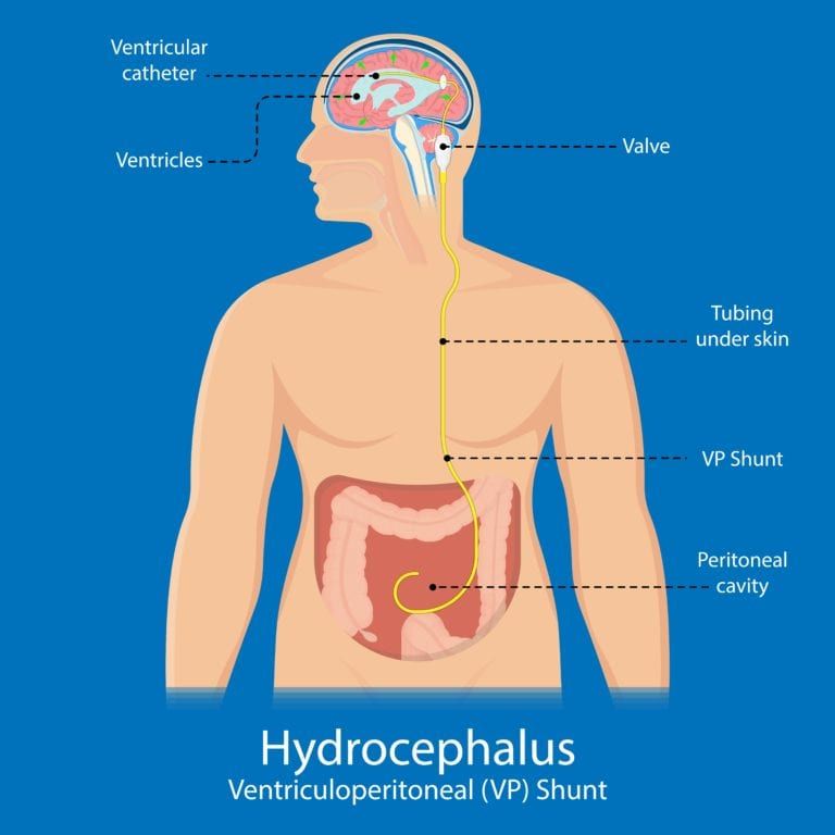 hydrocephalus shunt problems