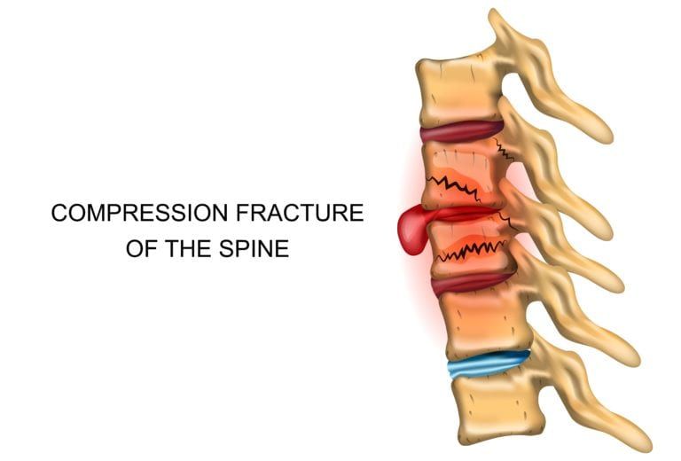 How To Prevent Compression Fractures » Fort Worth Neurosurgeon - Dr. Diana  Wilson