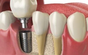Rendering of Dental Implants