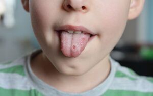 Child with Oral Lichen Planus on Tongue