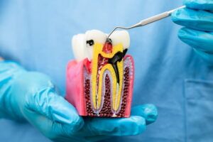 Asian dentist holding dental implant, artificial tooth roots into jaw, root canal of dental treatment, gum disease, teeth model for dentist.