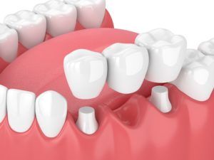 dental bridge computerized image