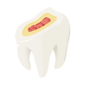 image of tooth with the three layers exposed