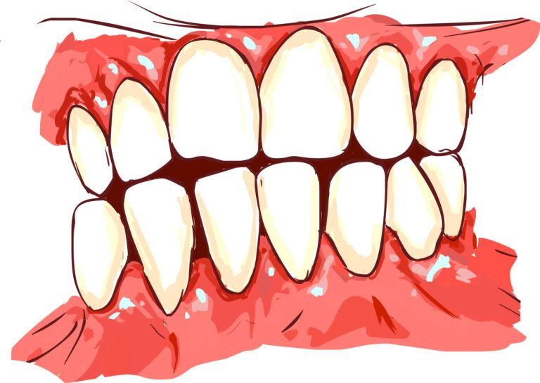 Gum recession and gum disease