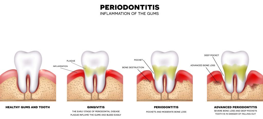 Diagram of healthy teeth, gingivitis, periodontitis, and advanced periodontitis 
