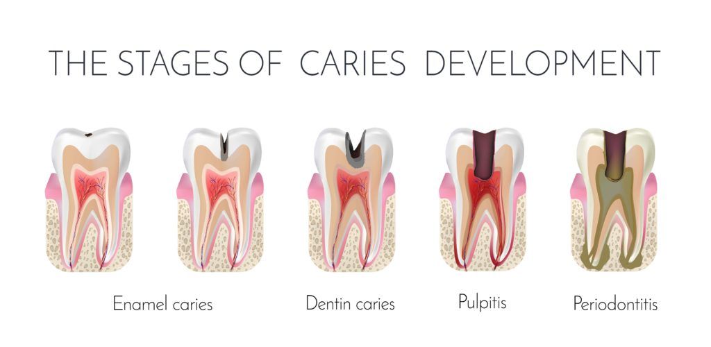 Various stages of cavity development from enamel cavities, to dentin cavities, to pulpitis, and finally to periodontitis.