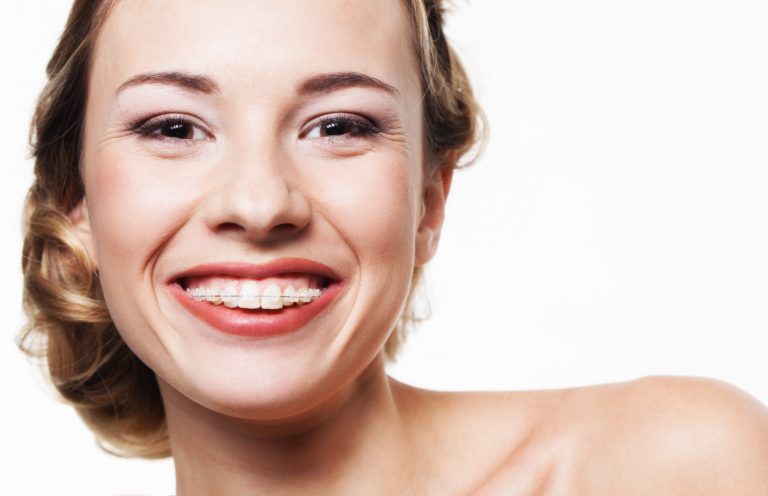 Girl smiling with ceramic braces