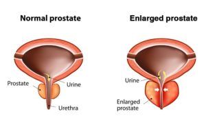 Diagram comparing a normal and enlarged prostate