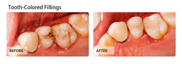 Teeth Whitening