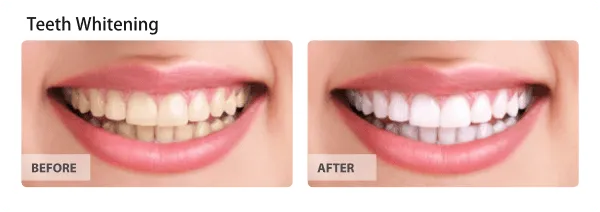 Porcelain Crowns