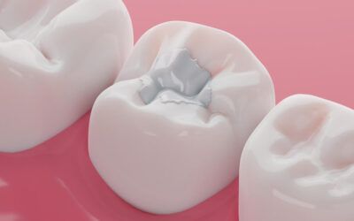 Composite Tooth-Colored Fillings