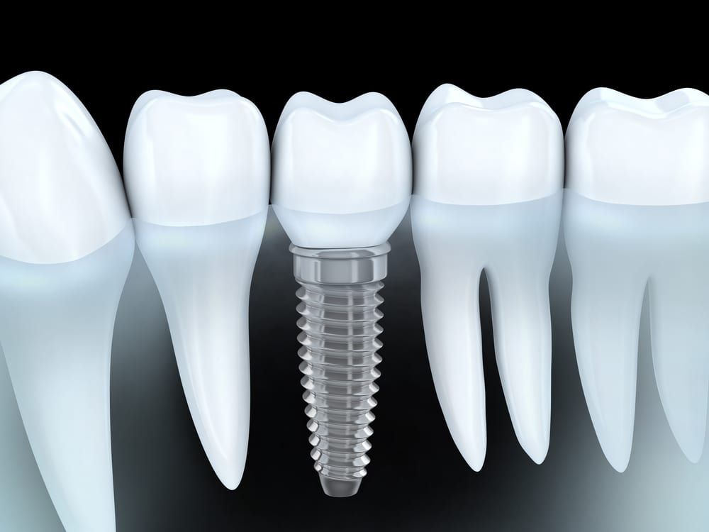 Dental Implant Image 01