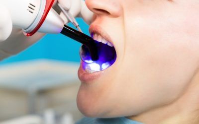 Cupertino Dental Bonding