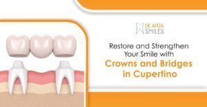 Crowns & Bridges in Cupertino | De Anza Smiles Dental