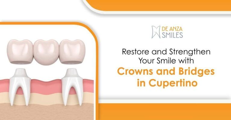 Crowns & Bridges in Cupertino | De Anza Smiles Dental