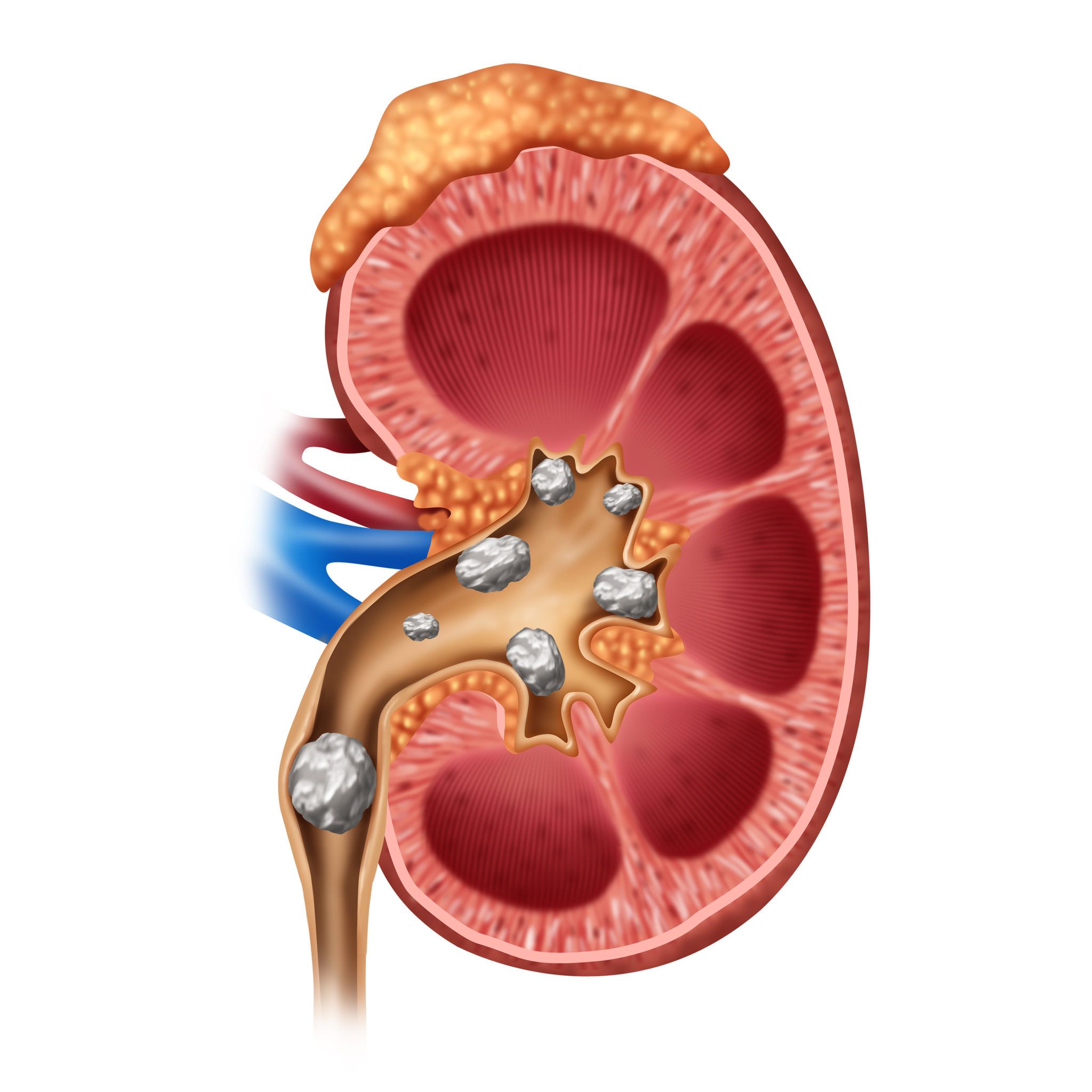 Kidney Stones » Bradenton, FL Urology Partners