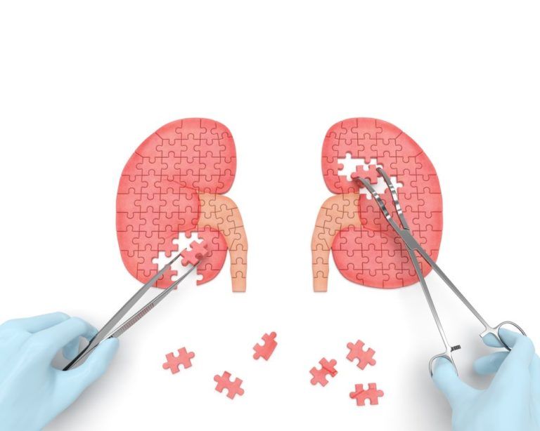 imgage of kidneys made of puzzle pieces and surgeon removing some pieces with surgical tools