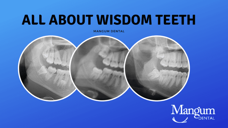 All About Wisdom Teeth