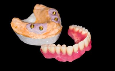 Implant Supported Dentures