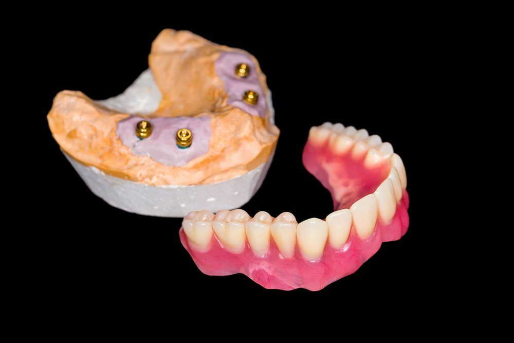 Implant Supported Dentures