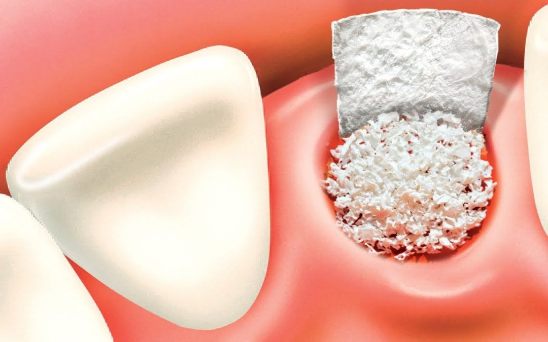 Bone Grafting