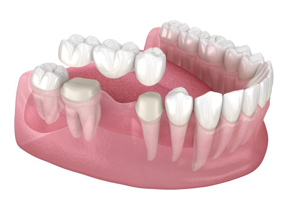 Everything You Need to Know About Dental Crowns and Bridges