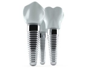 dental-implants-what-you-need-to-know