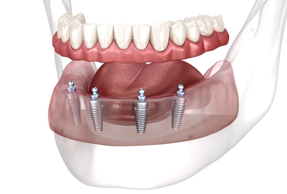 Rediscover Confidence with Implant-Supported Dentures: A Comprehensive Solution